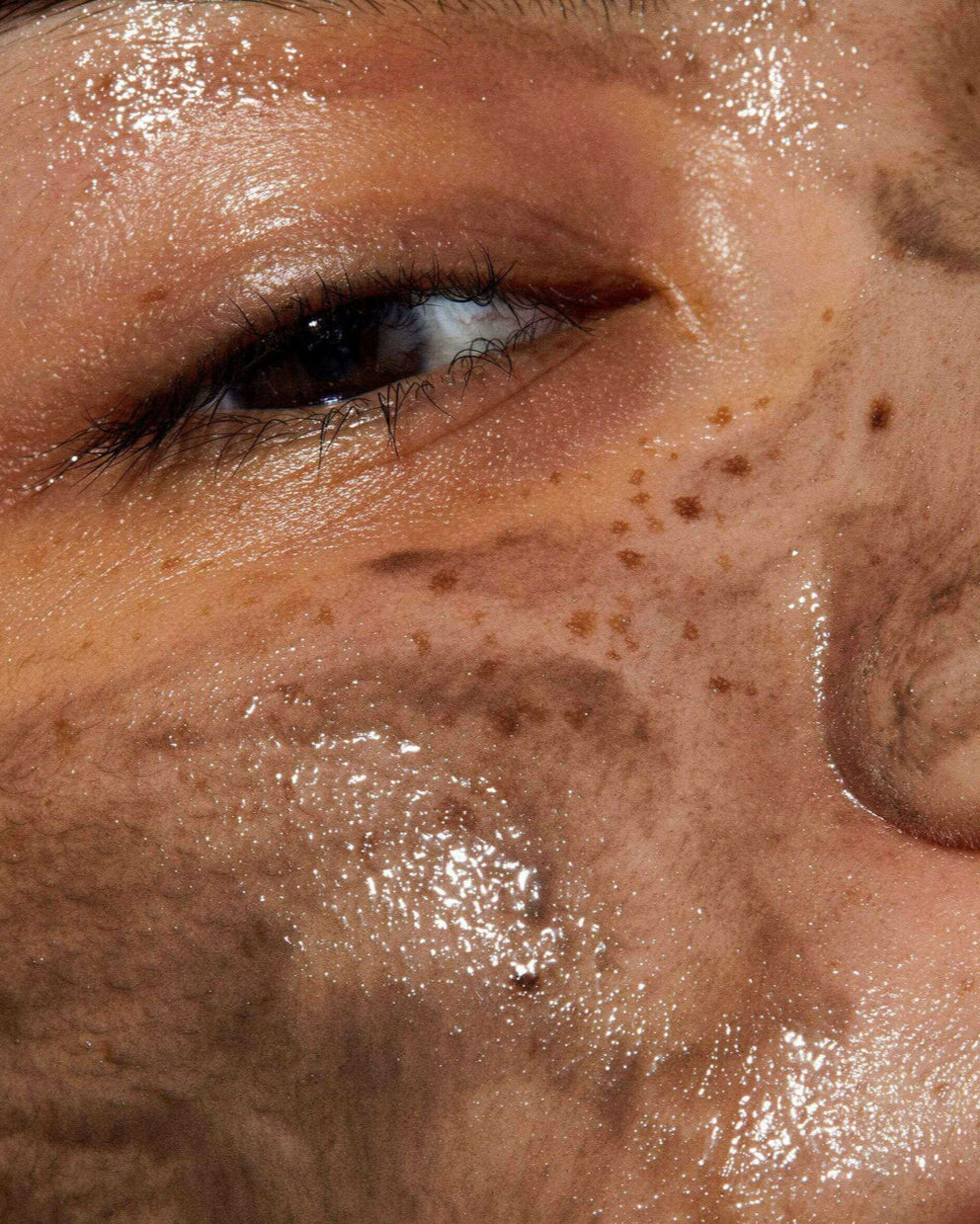 Close-up of a person's eye with visible skin treatment.