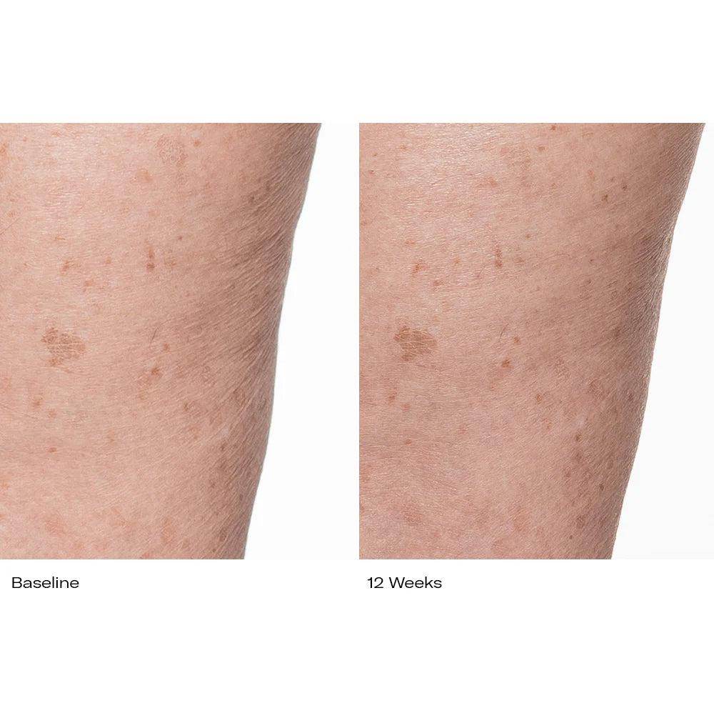Before and after skin improvement using Plumbody Plum Oil Body Cream over 12 weeks showing reduced spots