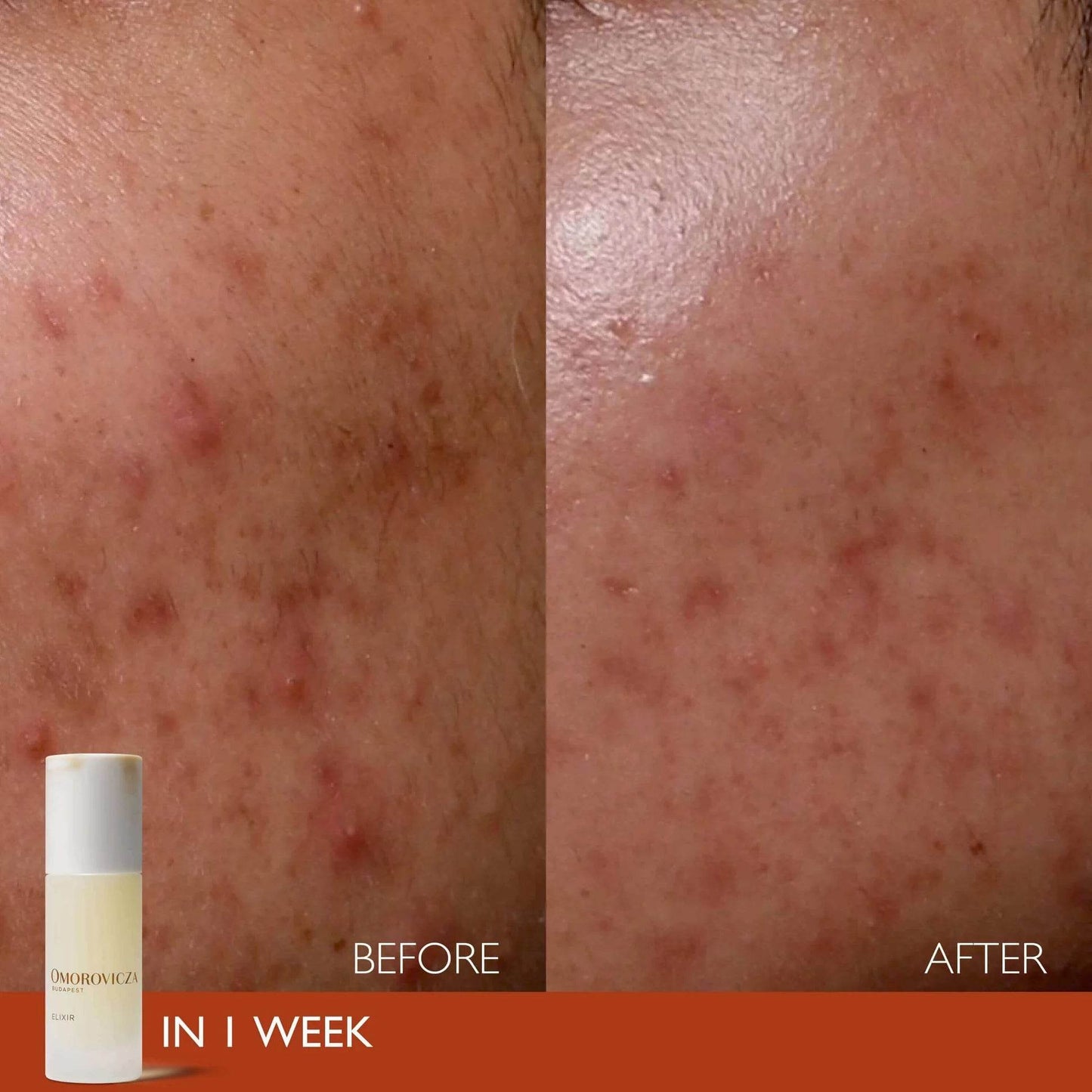 Omorovicza Active Serum before and after results showing improved skin clarity in just one week