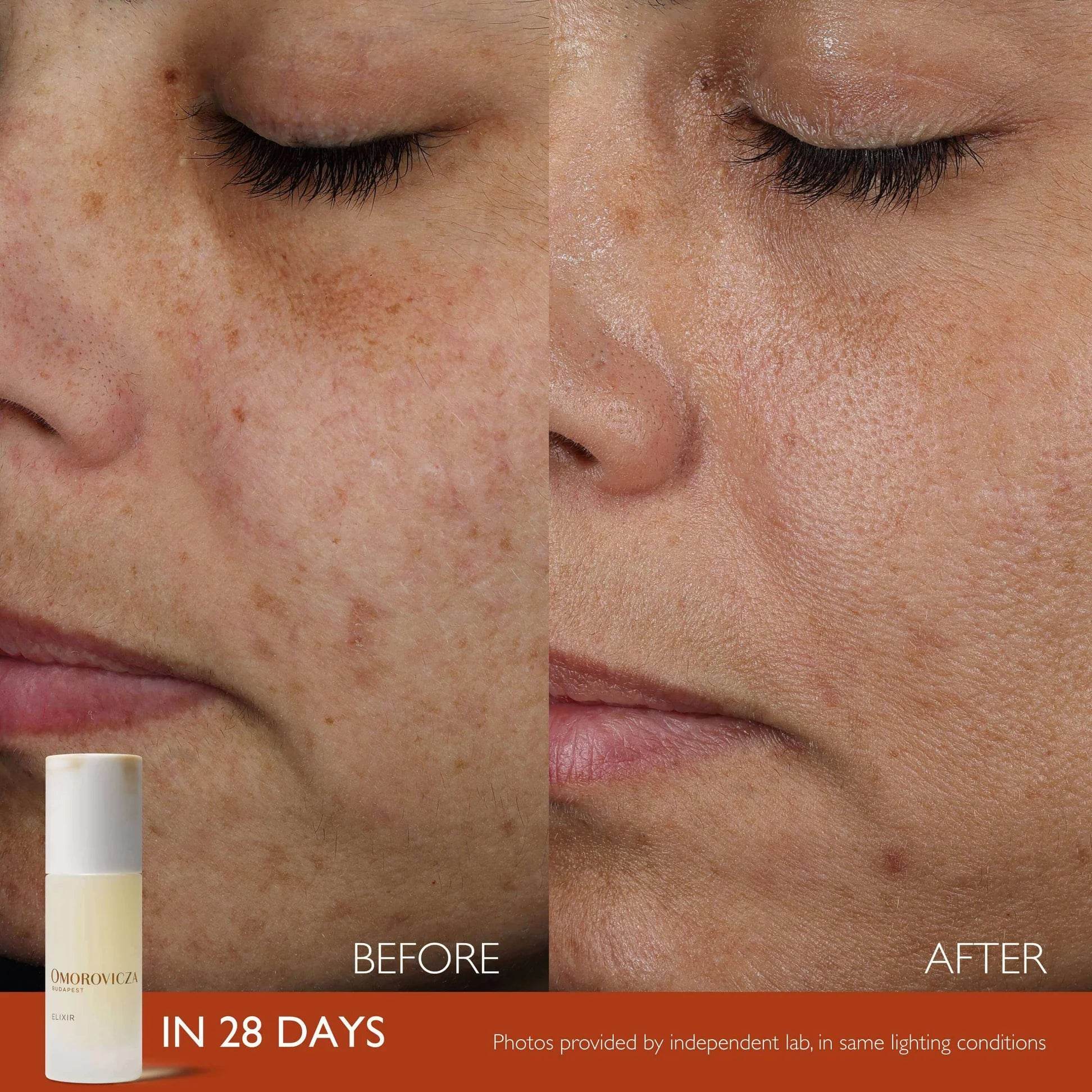 Before and after results of Omorovicza Active Serum showcasing improved skin texture and tone